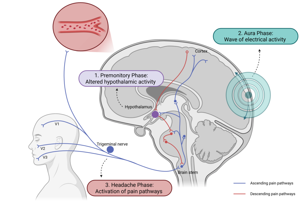 A diagram of a brain showing the areas in which the migraine phases occur